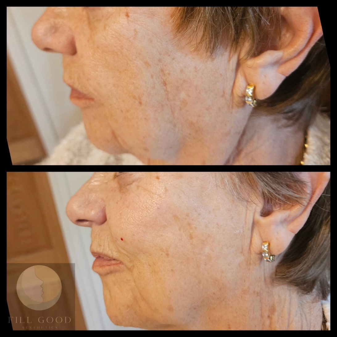 Before and after cheek filler: the lower face in three-quarter view, before above and after below.