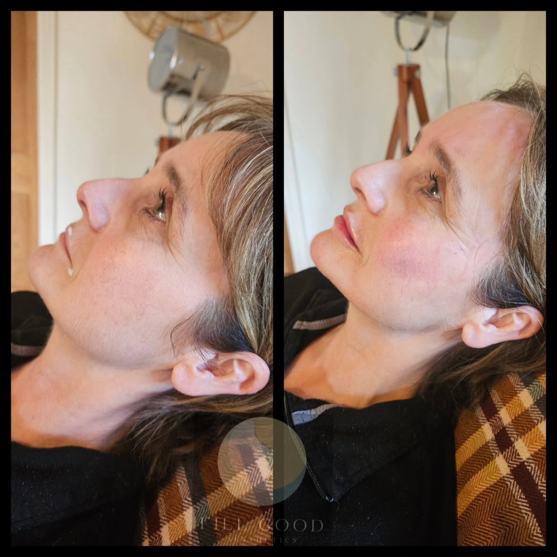 Before and after cheek and lip filler: the face tilted up in three-quarter view, before on the left and after on the right.