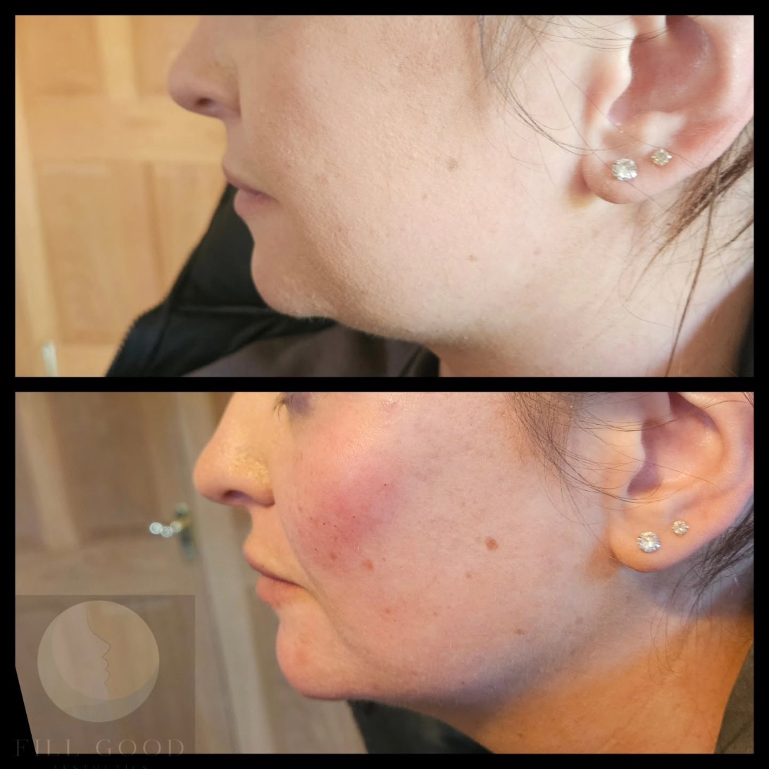 Before and after cheek and chin filler: the lower face in side profile, before above and after below. The after photograph shows redness over the cheek.