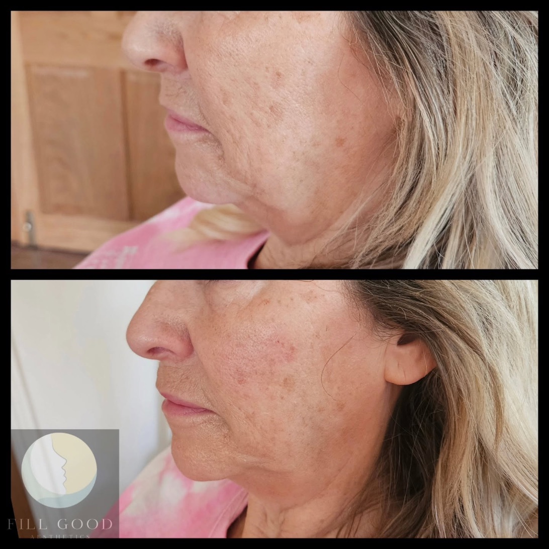 Before and after cheek filler: the lower face in three-quarter view, before above and after below.