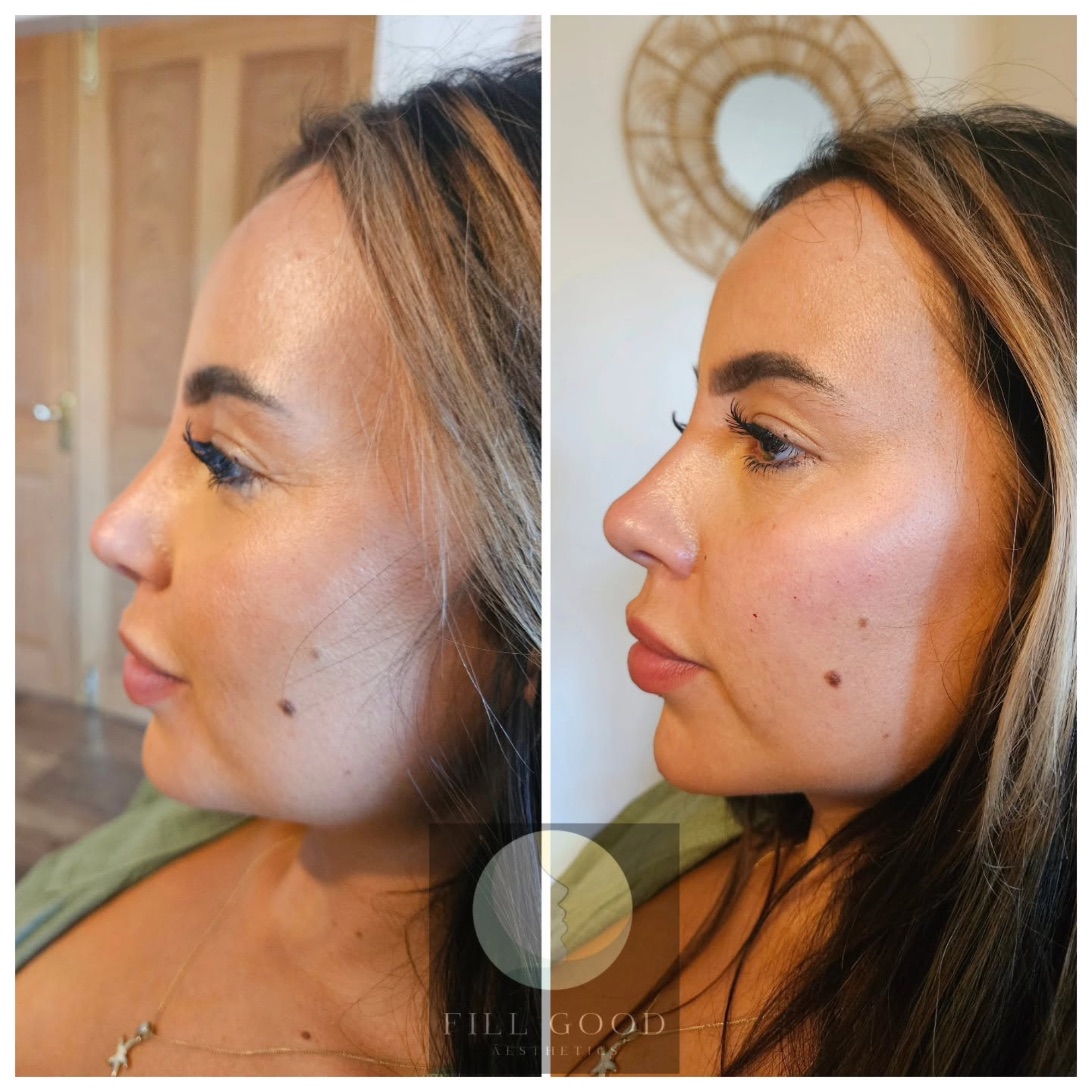 Before and after cheek filler: the face in three-quarter view, before on the left and after on the right.
