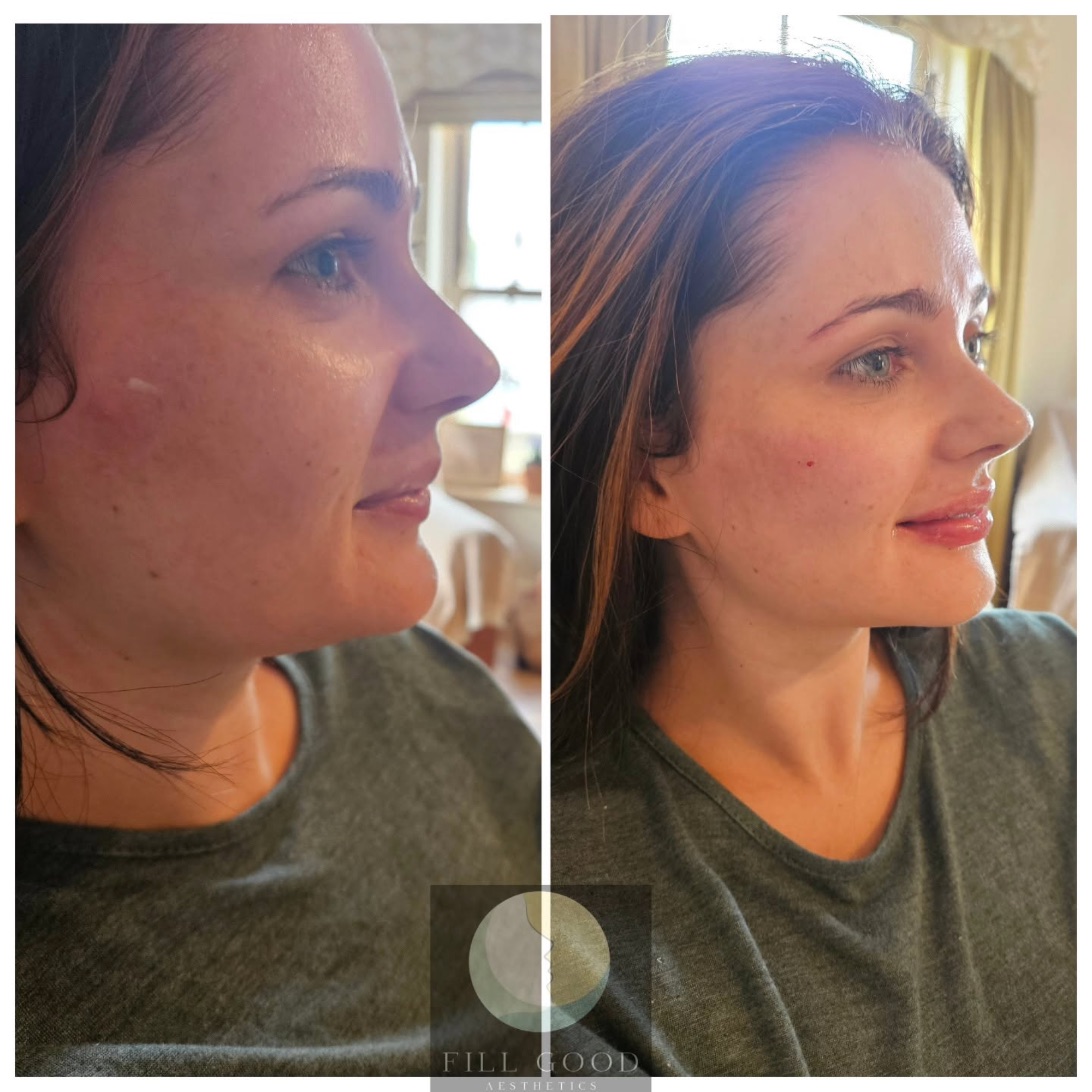 Before and after cheek and lip filler: the face in three-quarter view, before on the left and after on the right.