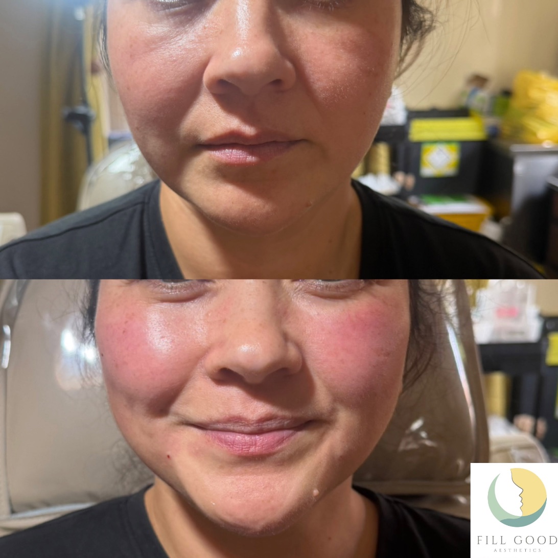 Before and after cheek filler: the lower face front on, before above and after below. The after photograph shows redness over the cheeks.