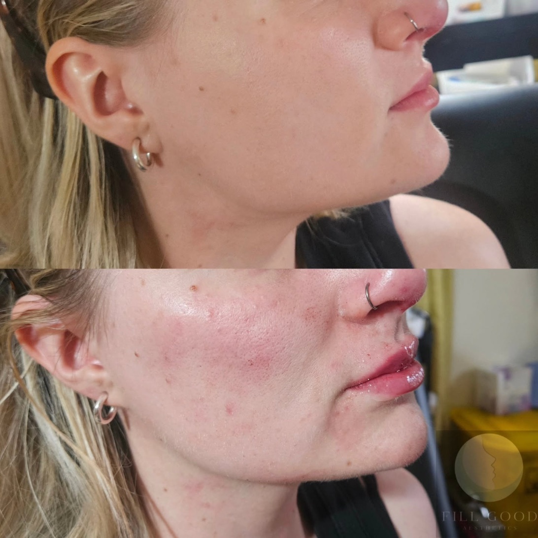 Before and after cheek, chin and lip filler: the lower face in side profile, before above and after below. The after photograph shows redness over the cheek.