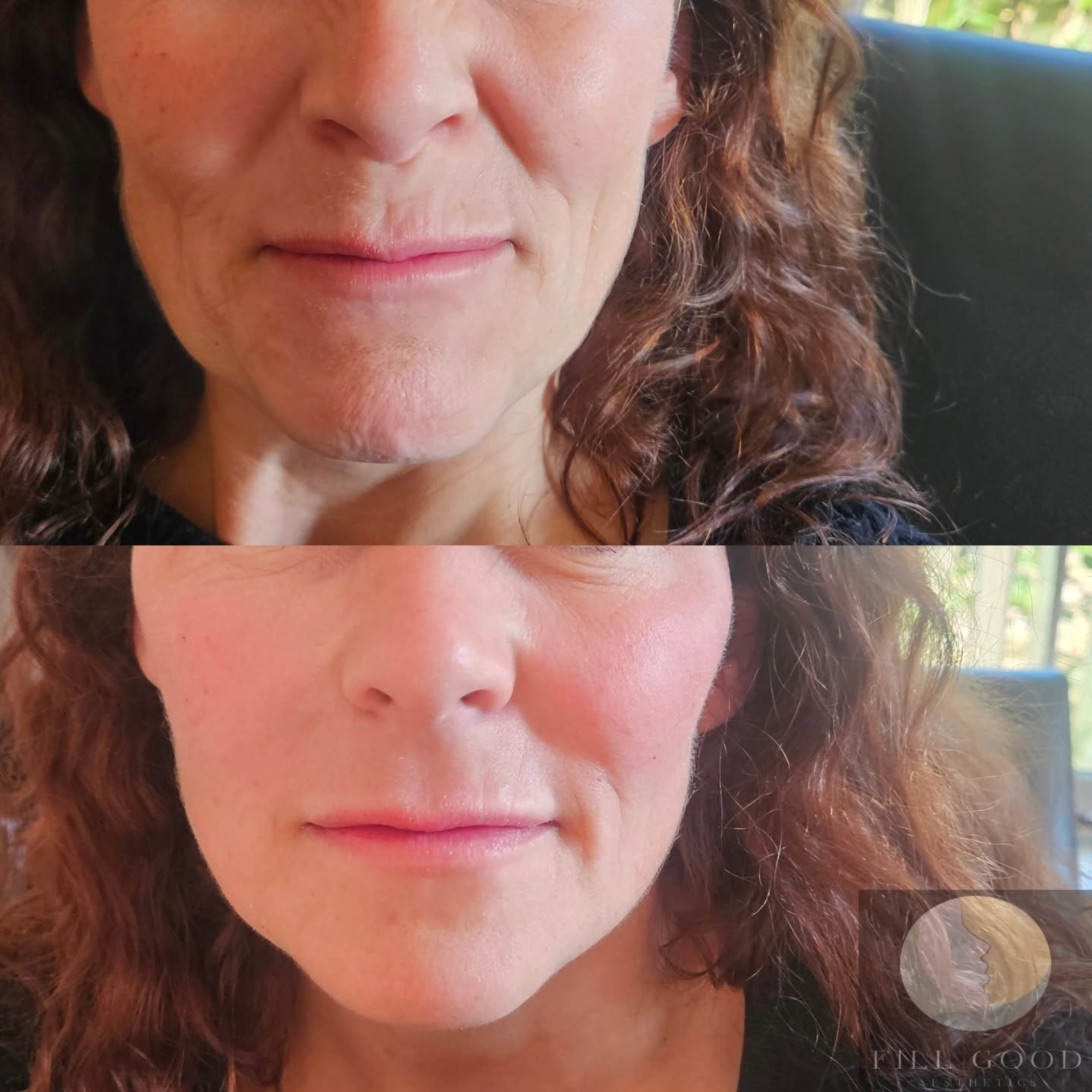 Before and after dermal filler: the lower face front on, before above and after below.