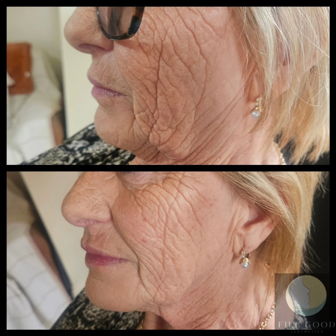 Before and after lip and cheek filler: the face in side profile, before above and after below.