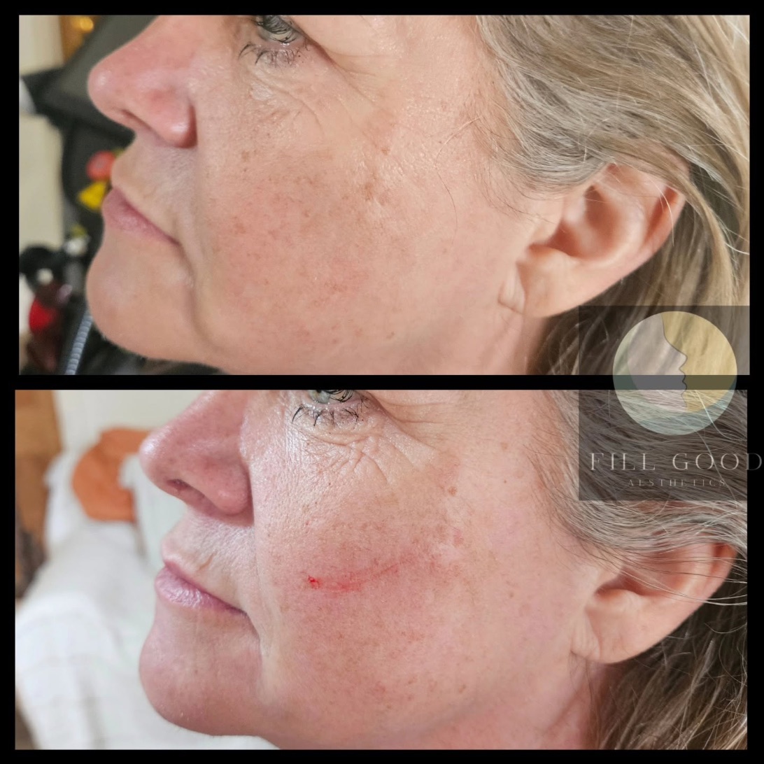Before and after cheek filler: the face in three-quarter view, before above and after below. The after photograph shows a small red mark on the cheek.
