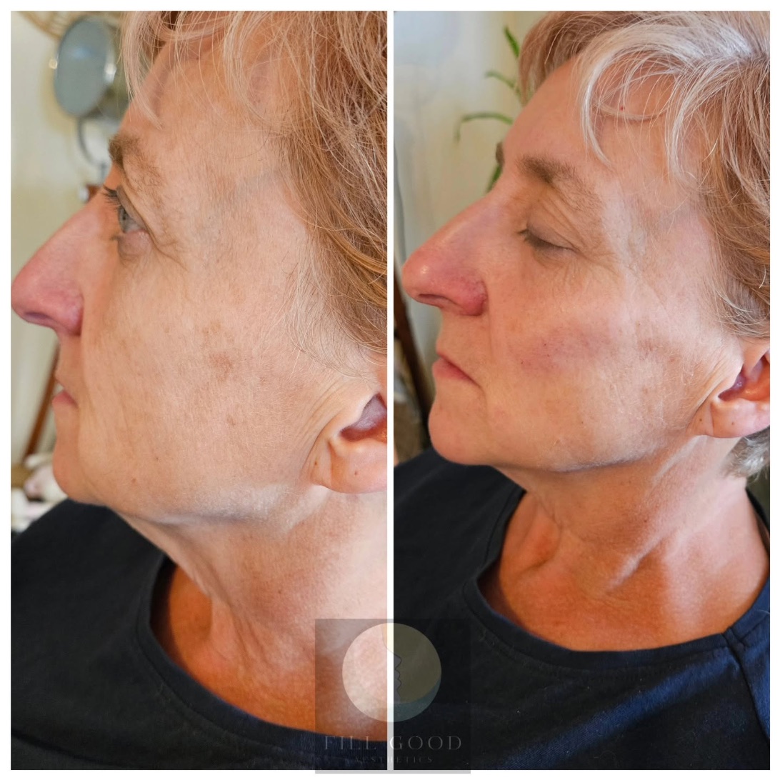 Before and after cheek filler: the face and neck in three-quarter view, before on the left and after on the right.