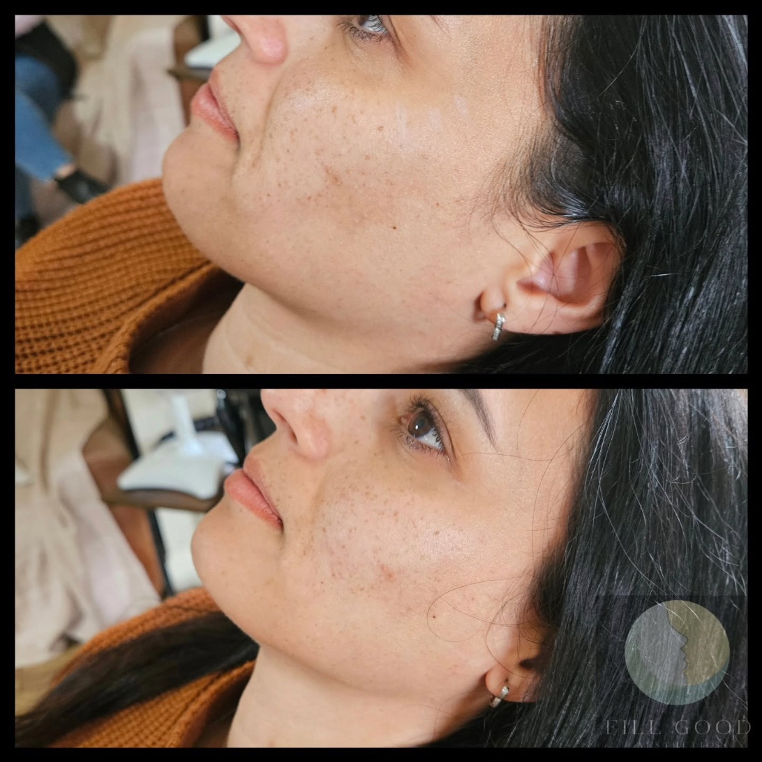 Before and after cheek filler: the face tilted up in three-quarter view, before above and after below.
