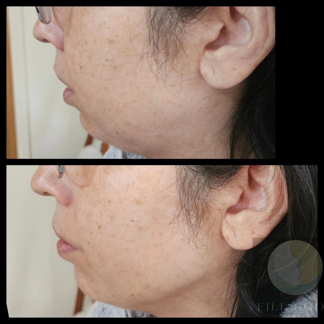 Before and after chin filler: the lower face in side profile, before above and after below.