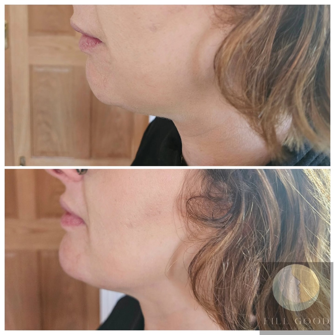 Before and after chin filler: the lower face and neck in side profile, before above and after below.