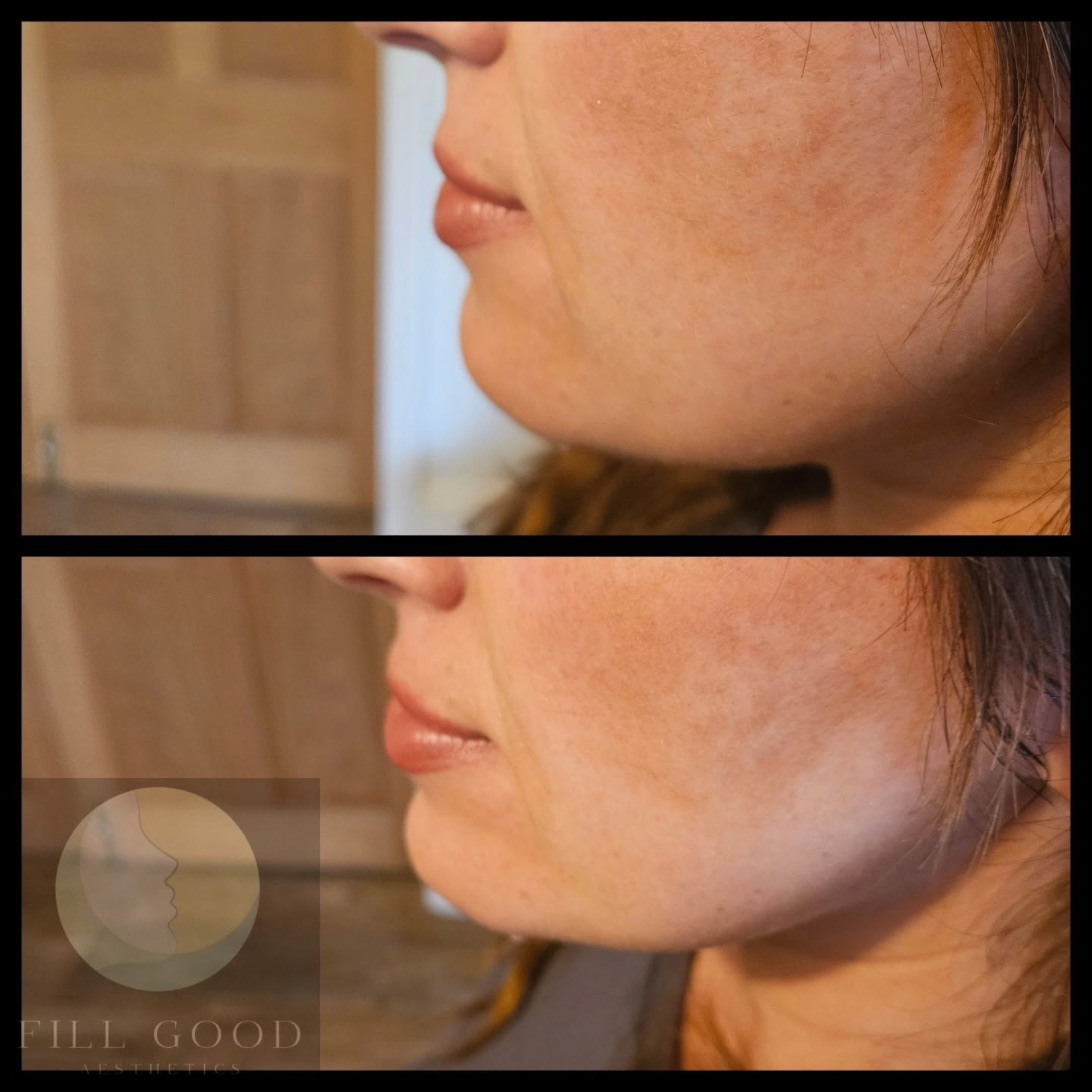 Before and after chin filler: the lower face in side profile, before above and after below.