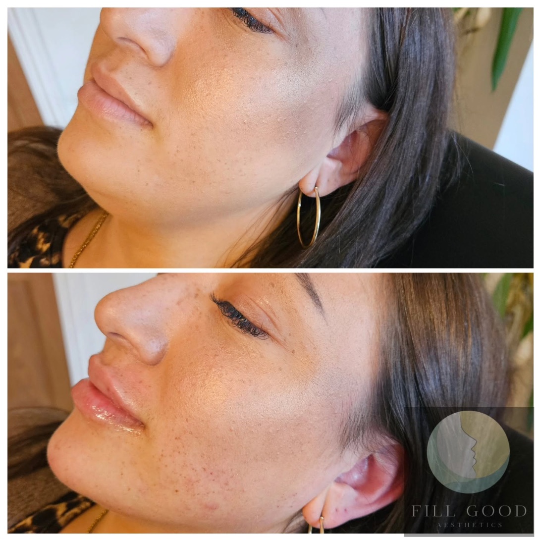 Before and after lip and chin filler: the lower face in three-quarter view from below, before above and after below.