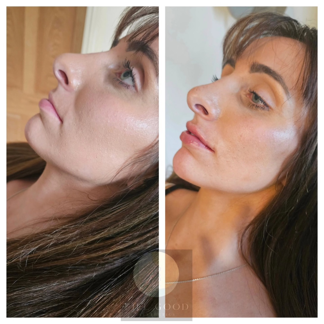 Before and after lip and chin filler: the face tilted up in three-quarter view, before on the left and after on the right.