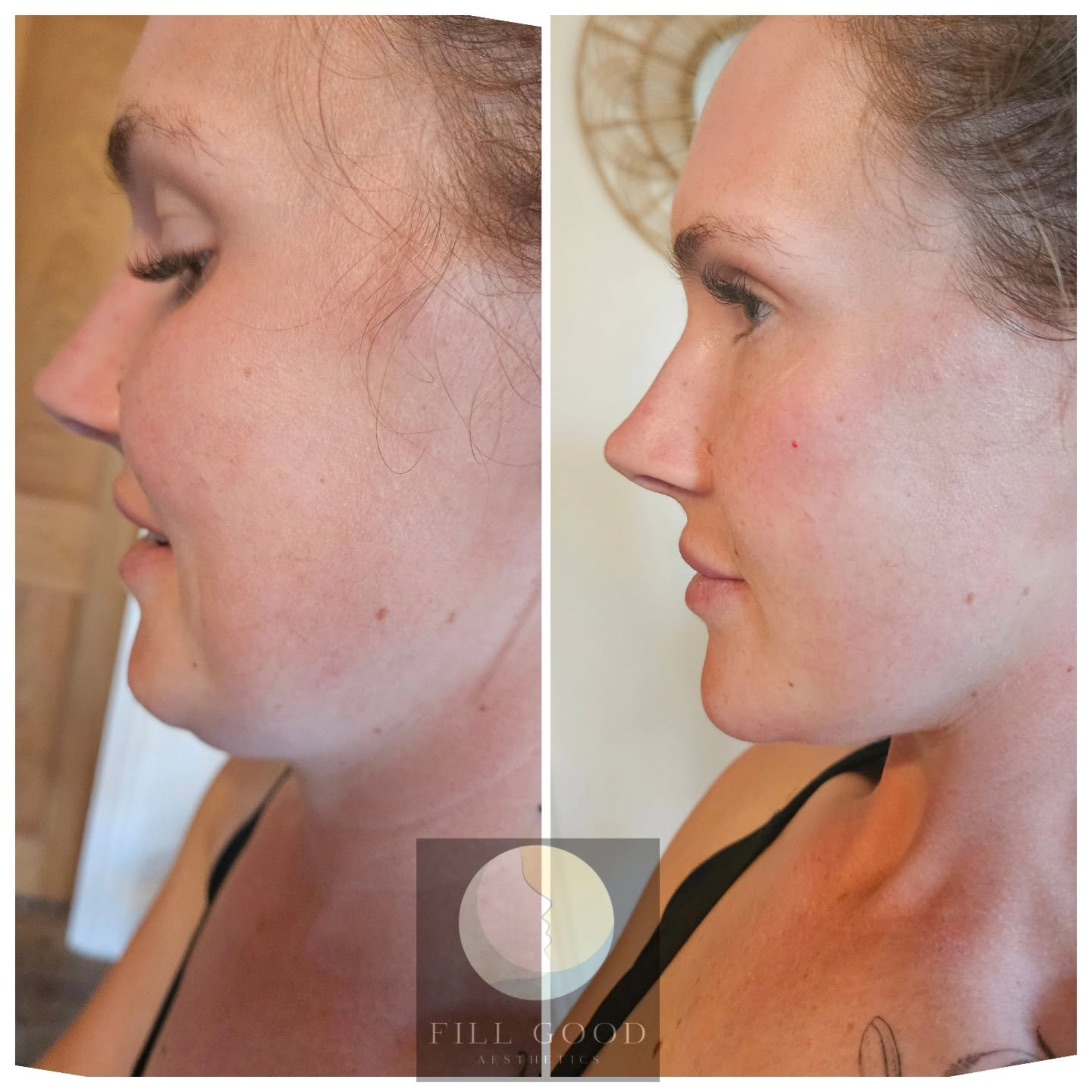 Before and after chin and cheek filler: the lower face and neck in side profile, before on the left and after on the right.