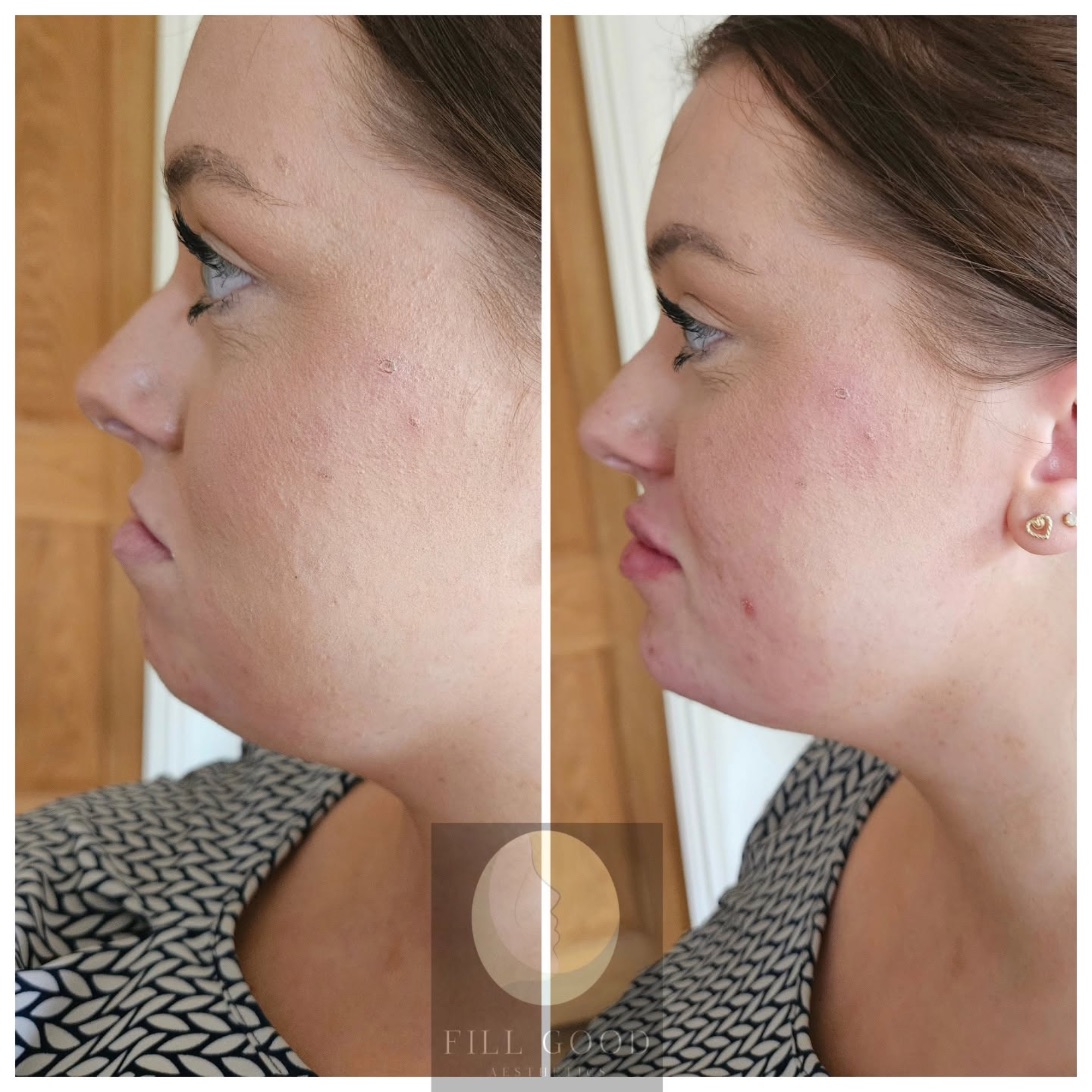 Before and after chin filler: the face and neck in side profile, before on the left and after on the right.