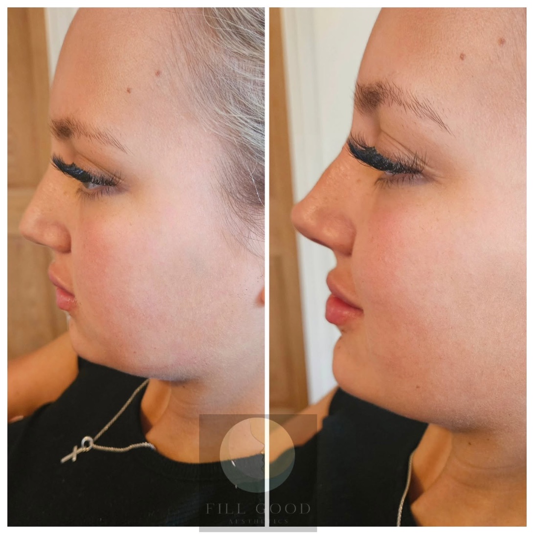 Before and after chin filler: the face in side profile, before on the left and after on the right. The after photograph is framed closer.