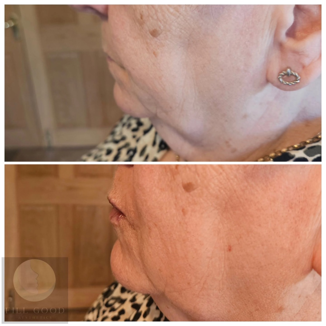 Before and after chin filler: the lower face and jaw in side profile, before above and after below.