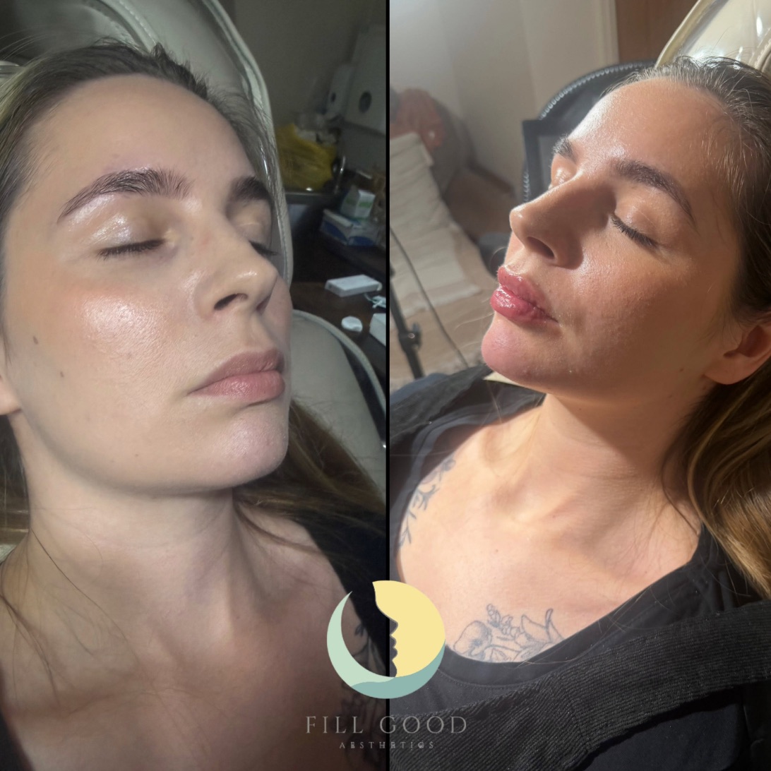 Before and after lip and chin filler: the face tilted back in three-quarter view, before on the left and after on the right.