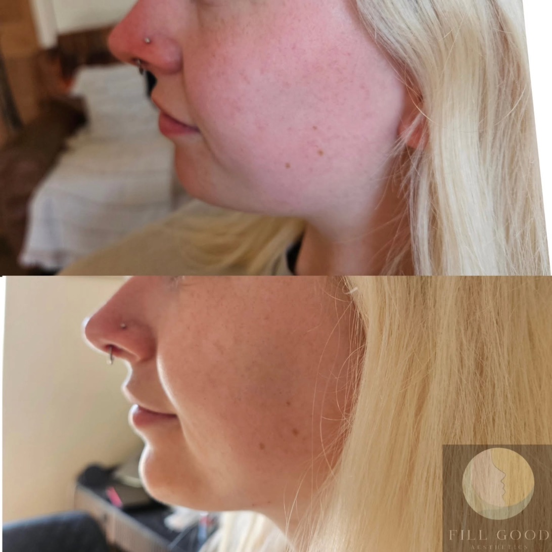 Before and after chin filler: the lower face in side profile, before above and after below.
