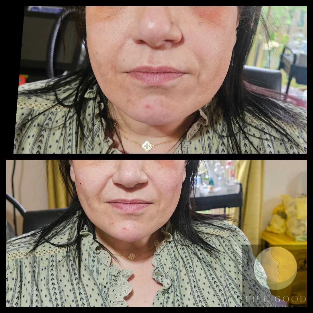 Before and after chin and cheek filler: the lower face front on, before above and after below.