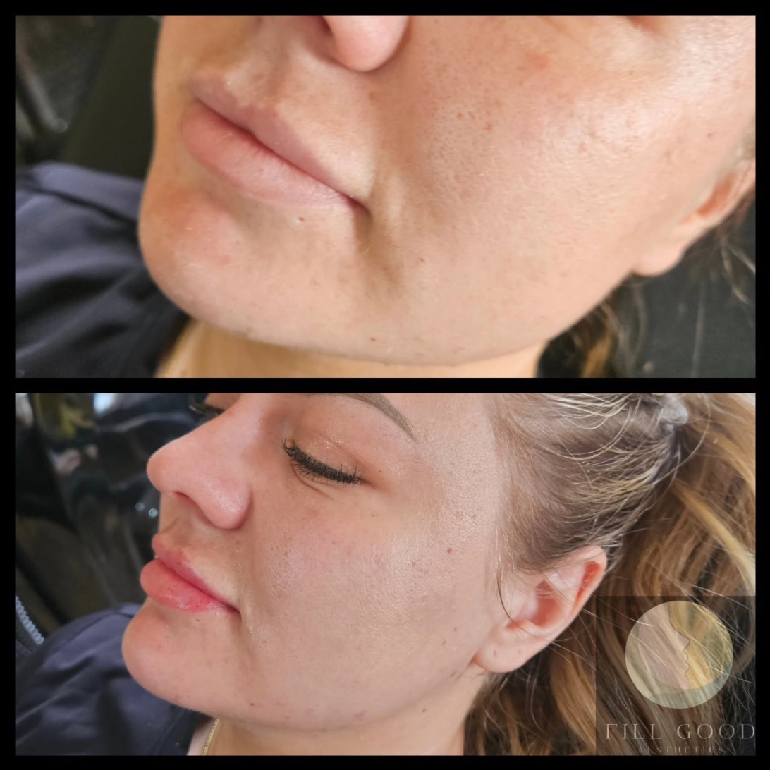 Before and after chin and lip filler: the lower face in three-quarter view, before above and after below.