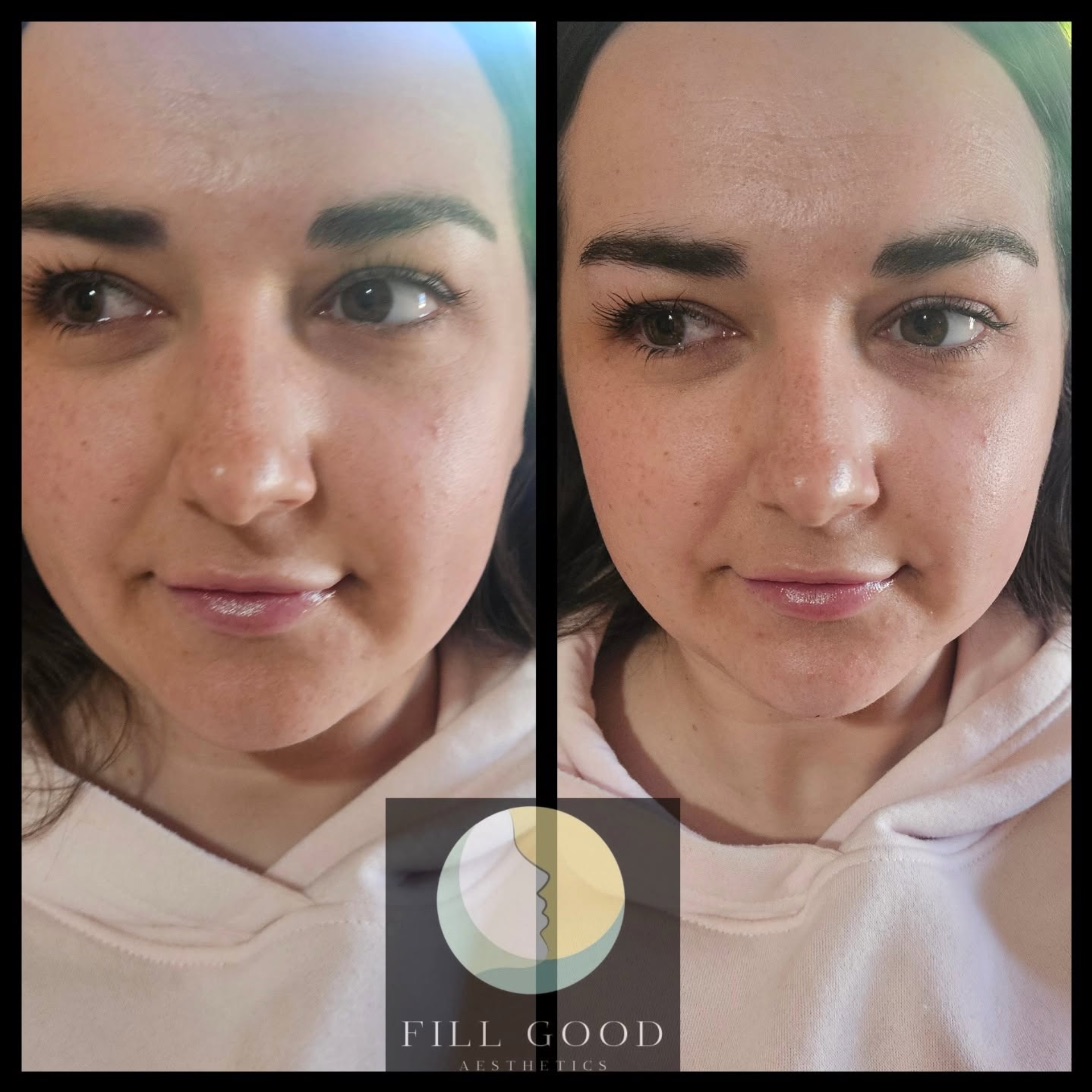 Before and after chin filler: the face front on from slightly below, before on the left and after on the right.