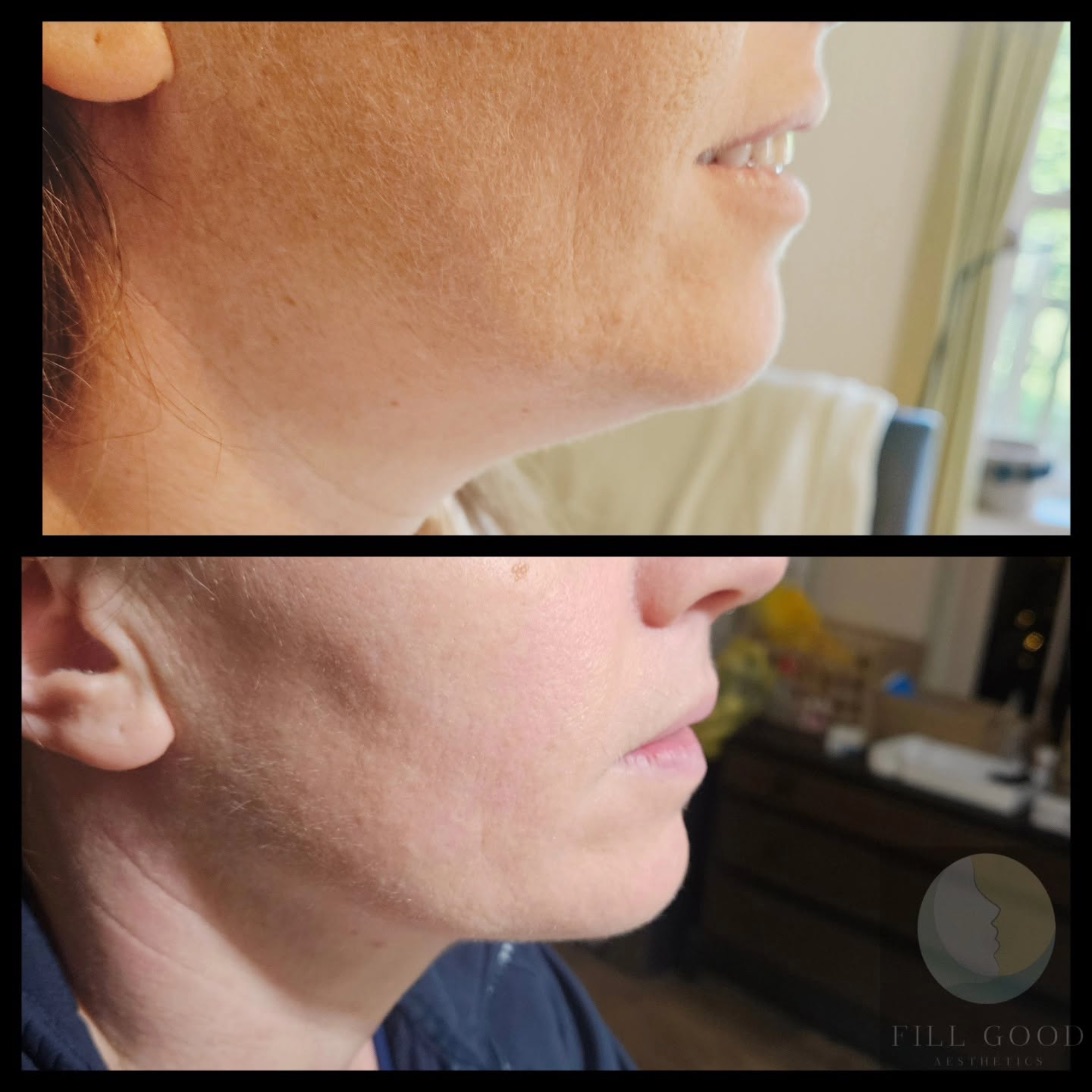 Before and after fat dissolving: the lower face and under the chin in side profile, before above and after below.