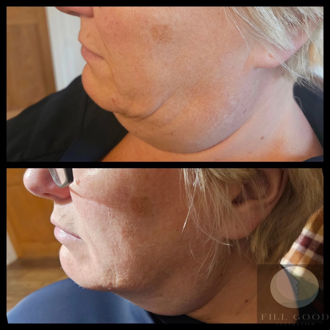 Before and after fat dissolving: the lower face and under the chin in three-quarter view, before above and after below.