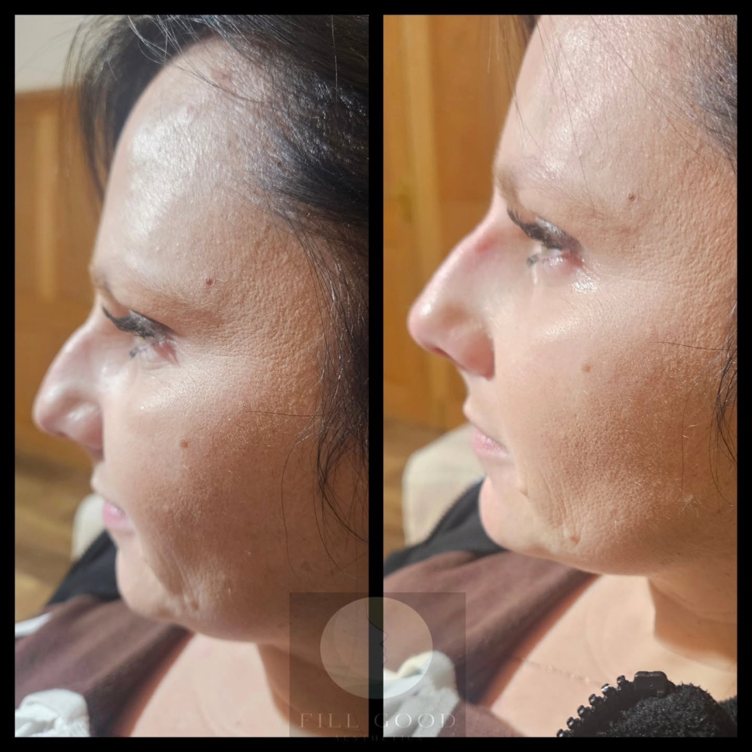 Before and after jawline and chin filler: the face in side profile, before on the left and after on the right.