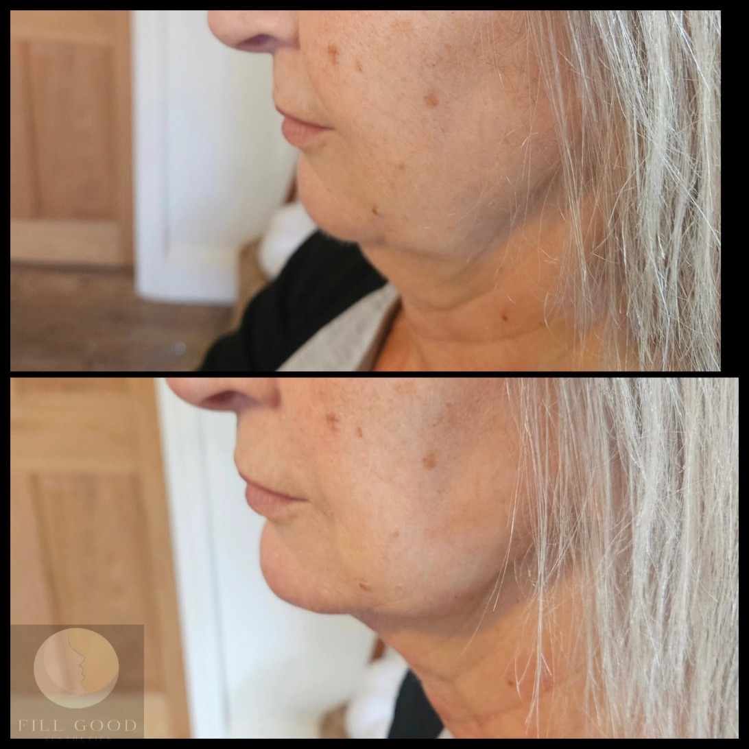 Before and after cheek and jawline filler: the lower face and jaw in three-quarter view, before above and after below.