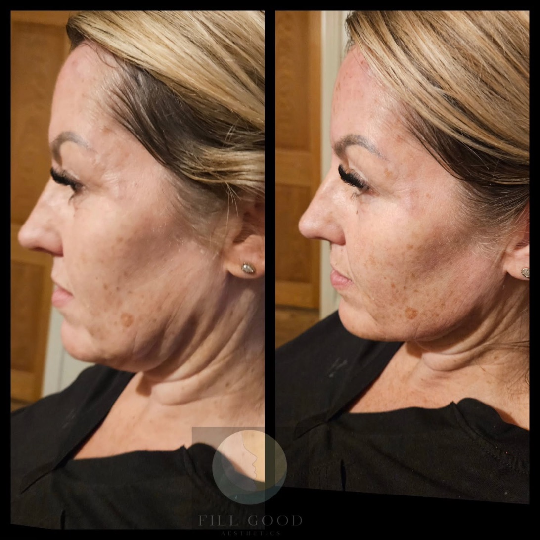 Before and after jawline filler: the face and neck in three-quarter view, before on the left and after on the right.