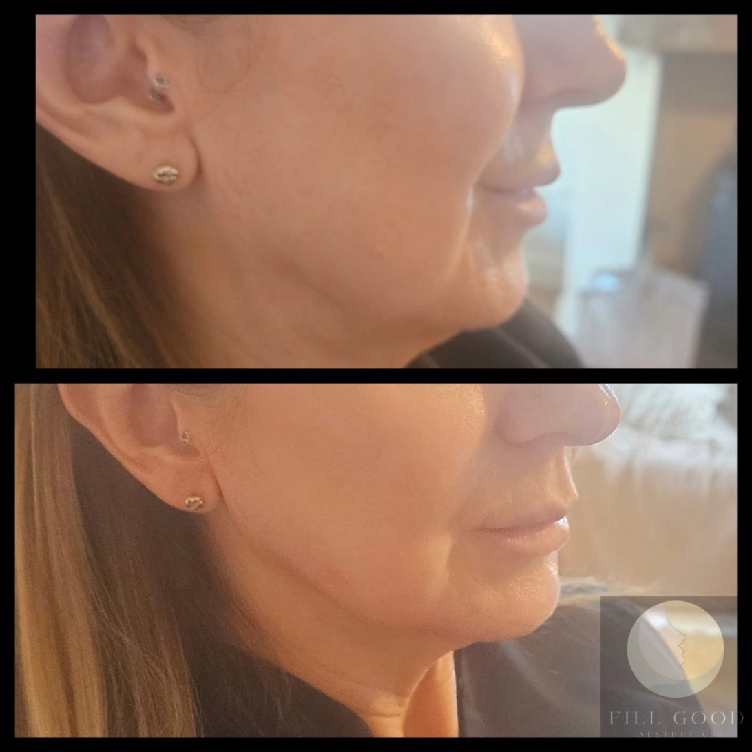 Before and after jawline and chin filler: the lower face and jaw in side profile, before above and after below.