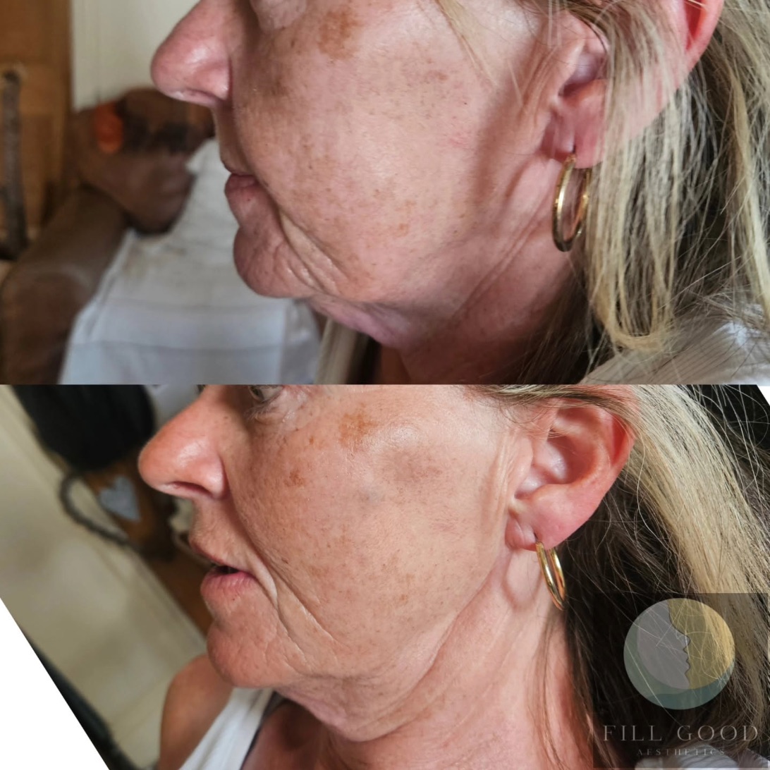 Before and after dermal filler: the lower face and jaw in side profile, before above and after below.