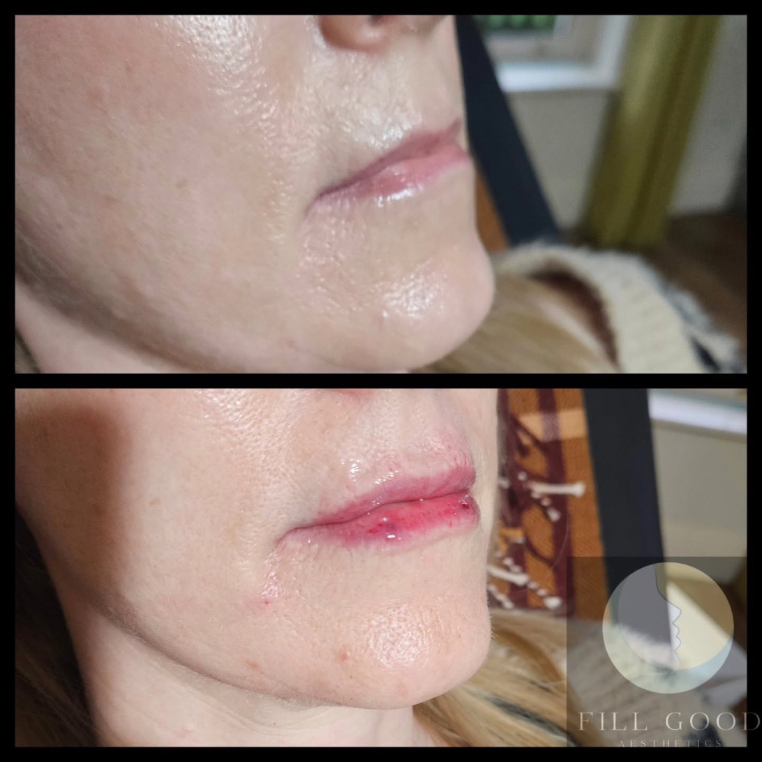 Before and after lip filler: the lips and chin in three-quarter view, before above and after below. The after photograph shows small red marks on the lips.