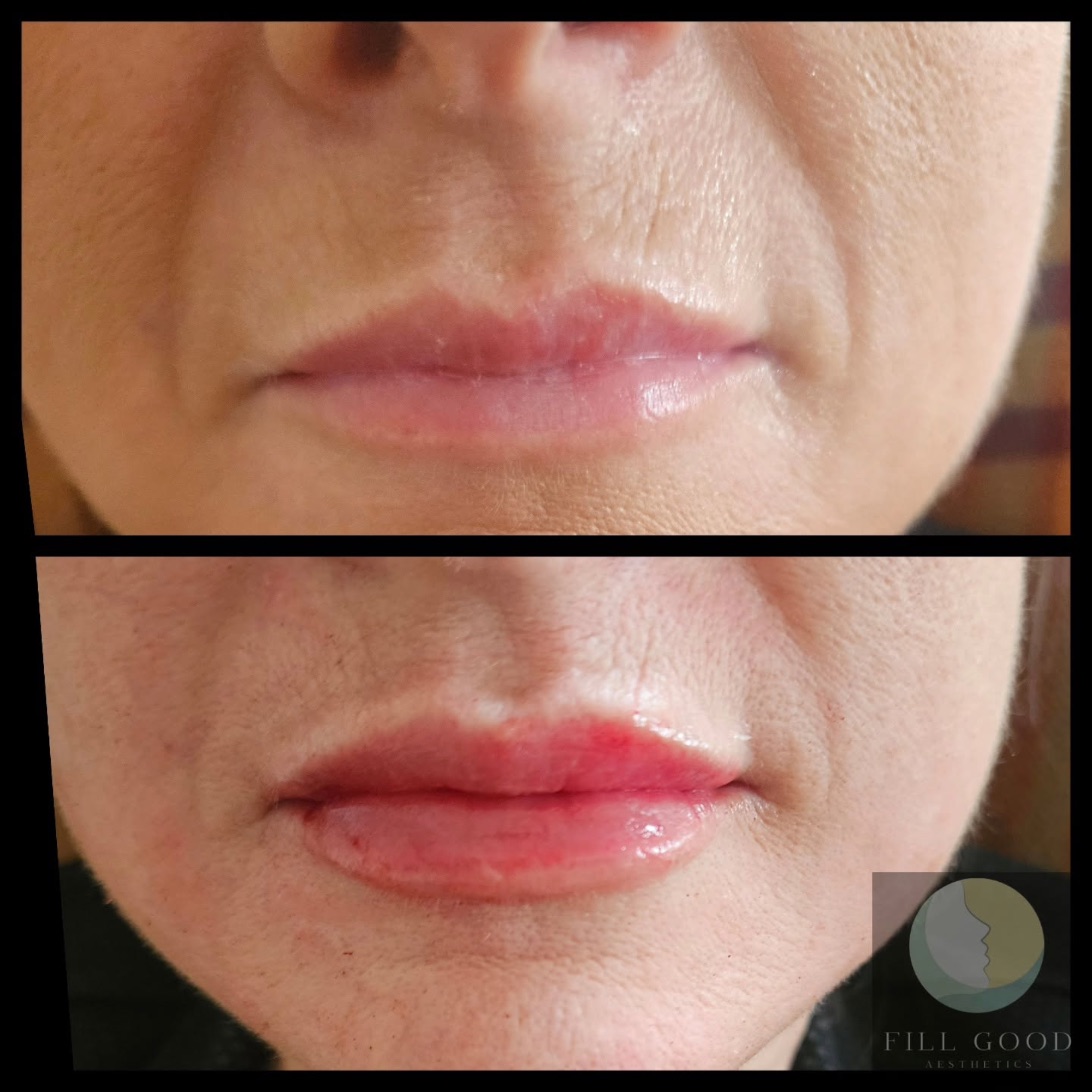 Before and after lip filler: the lips front on, mouth closed, before above and after below.