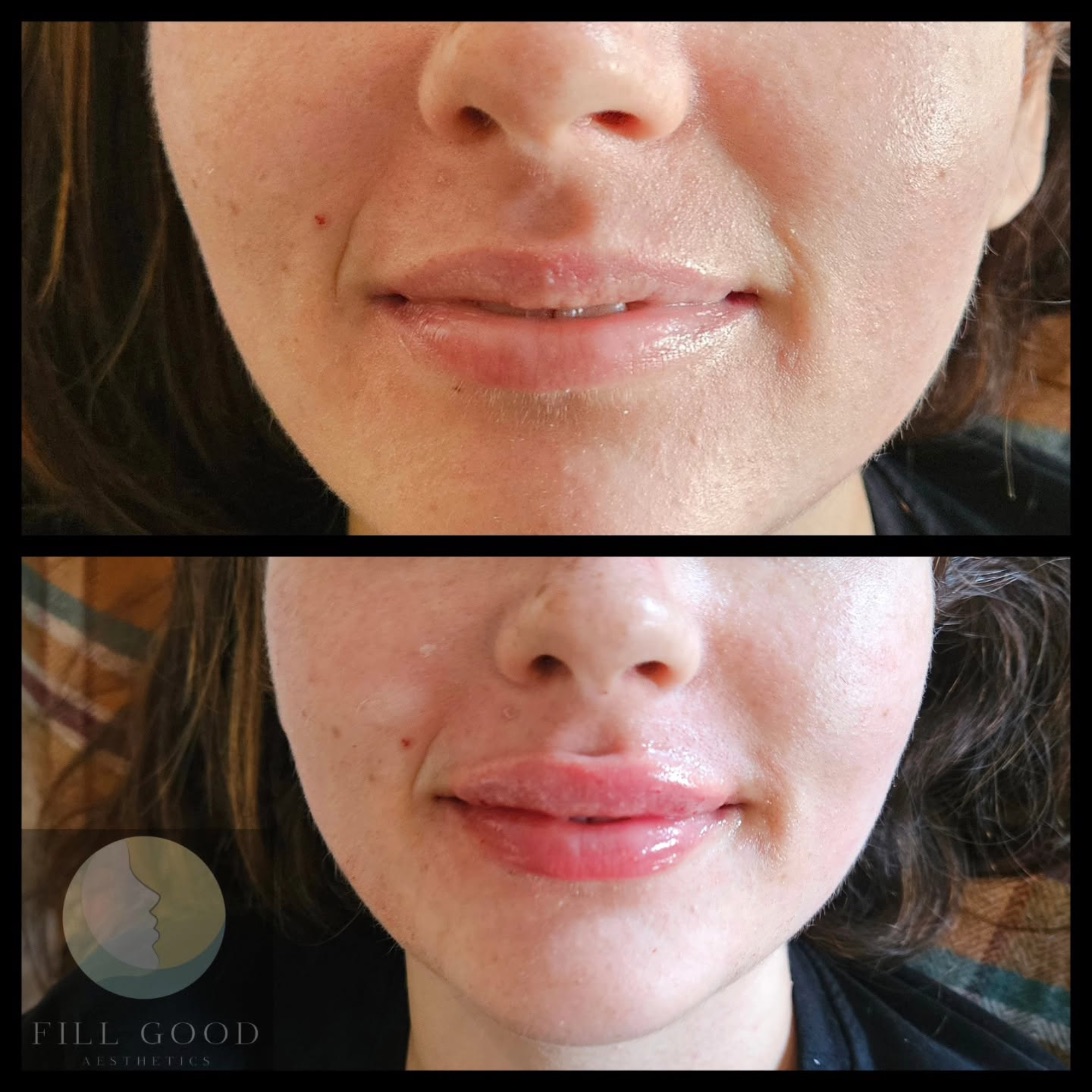 Before and after lip filler: the lower face front on, mouth closed, before above and after below.