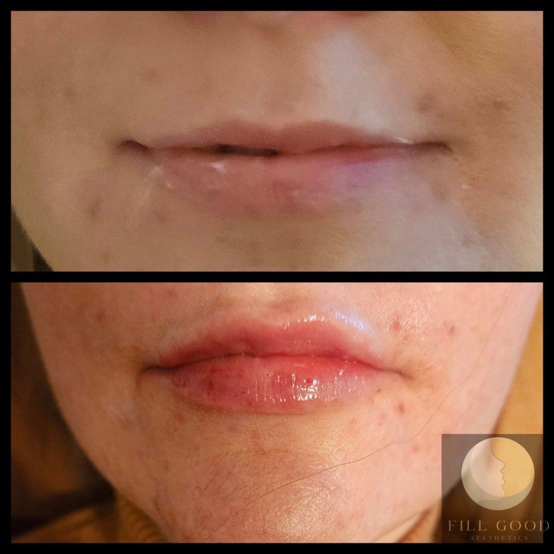Before and after lip filler: the lips front on, before above and after below. The after photograph shows small red marks around the lips.