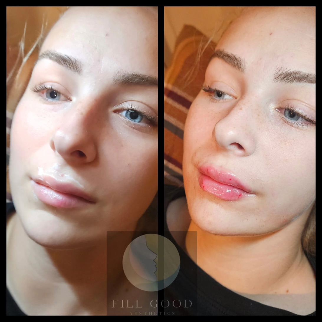 Before and after lip filler: the face from slightly below, before on the left and after on the right. The after photograph shows small red marks on the lips.