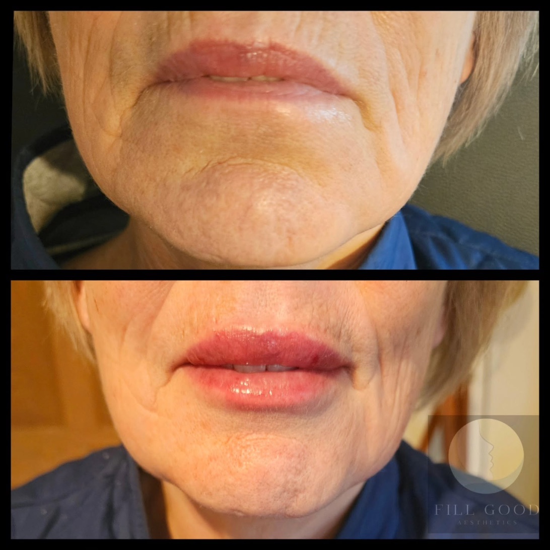 Before and after lip filler: the mouth and chin front on, before above and after below.