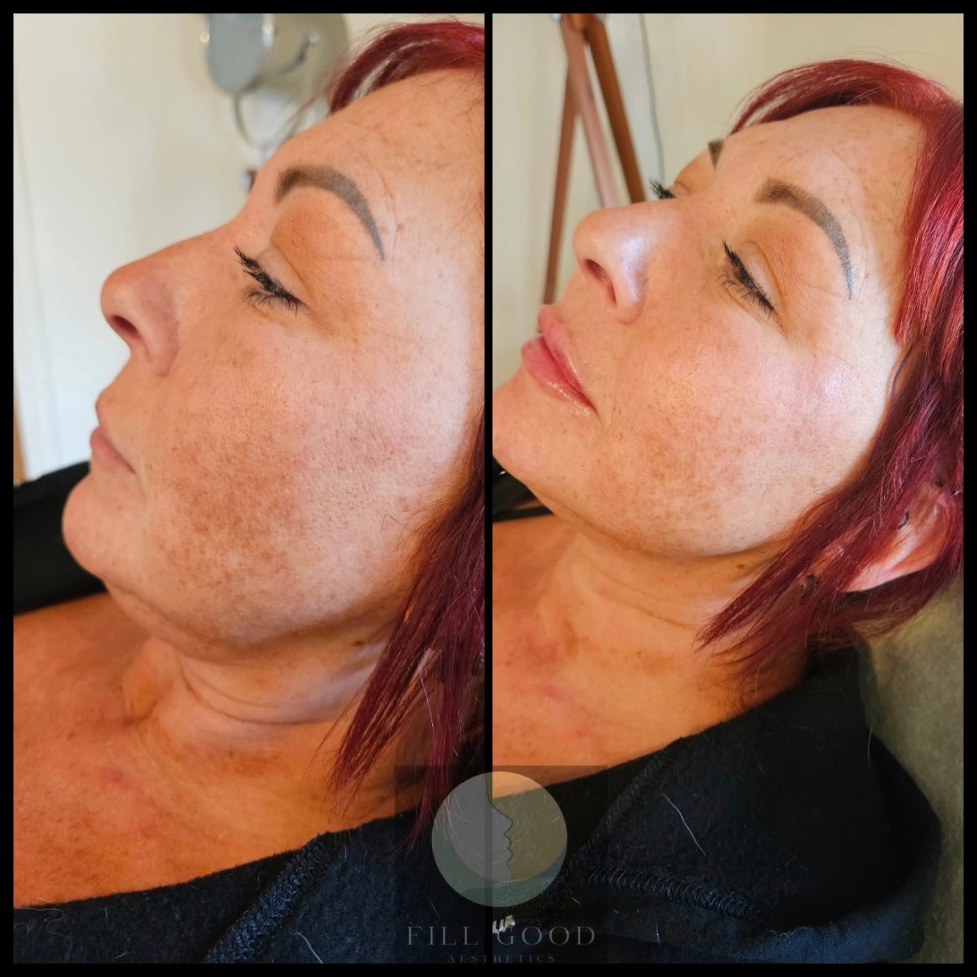 Before and after lip filler: the face tilted up in three-quarter view, before on the left and after on the right.