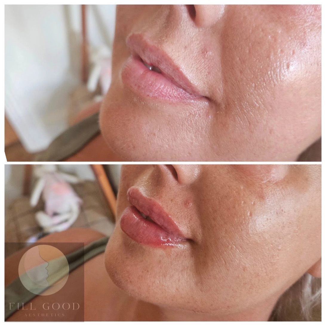 Before and after lip filler: the lips and chin in three-quarter view, before above and after below.