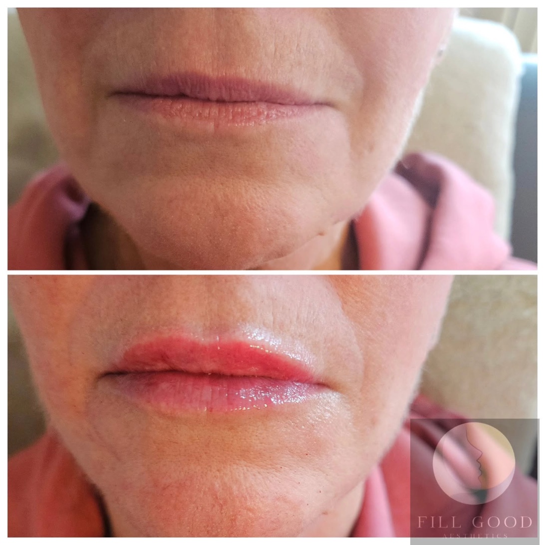 Before and after lip filler: the lips and chin front on, mouth closed, before above and after below.