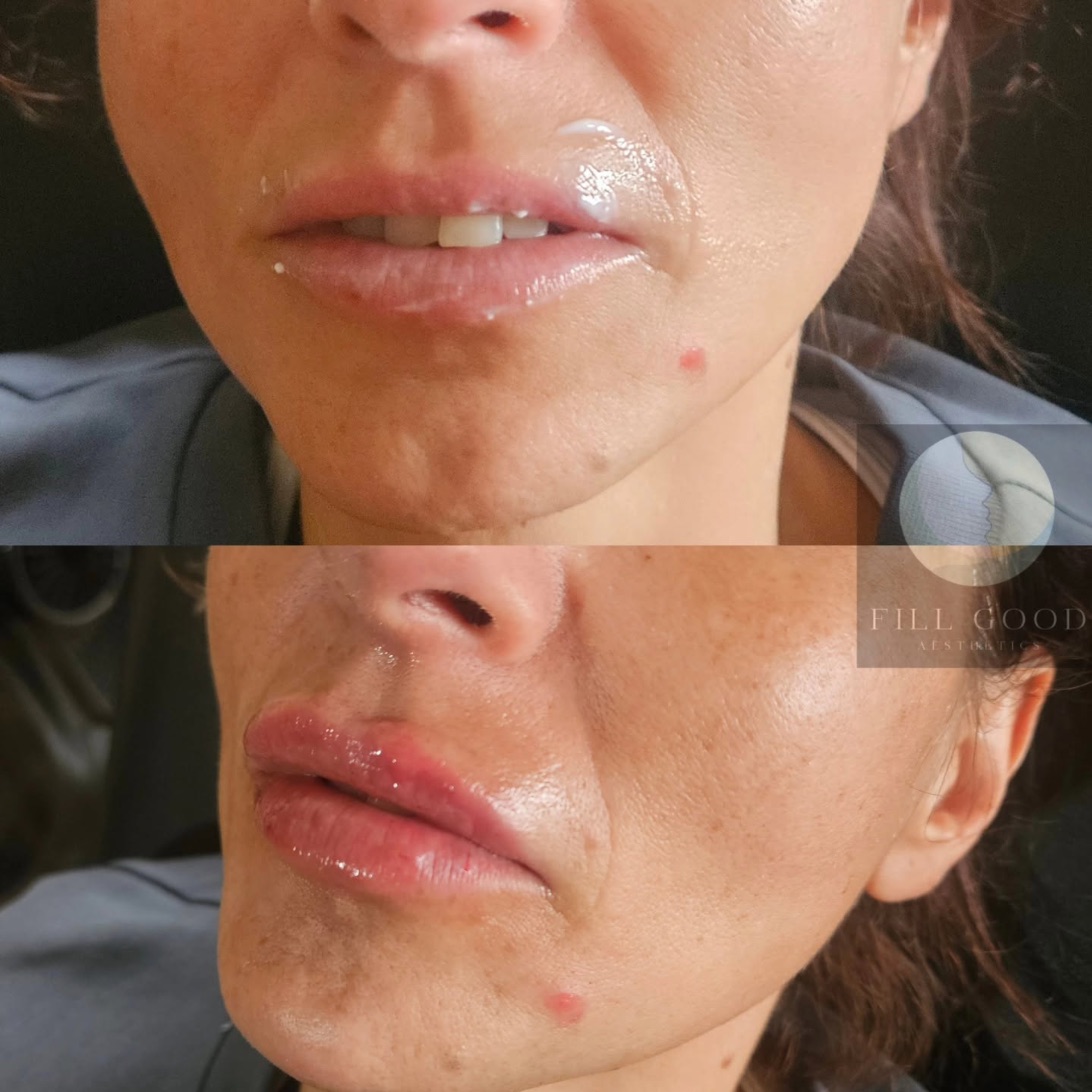 Before and after lip filler: the lips and chin, front on before and three-quarter after, before above and after below.
