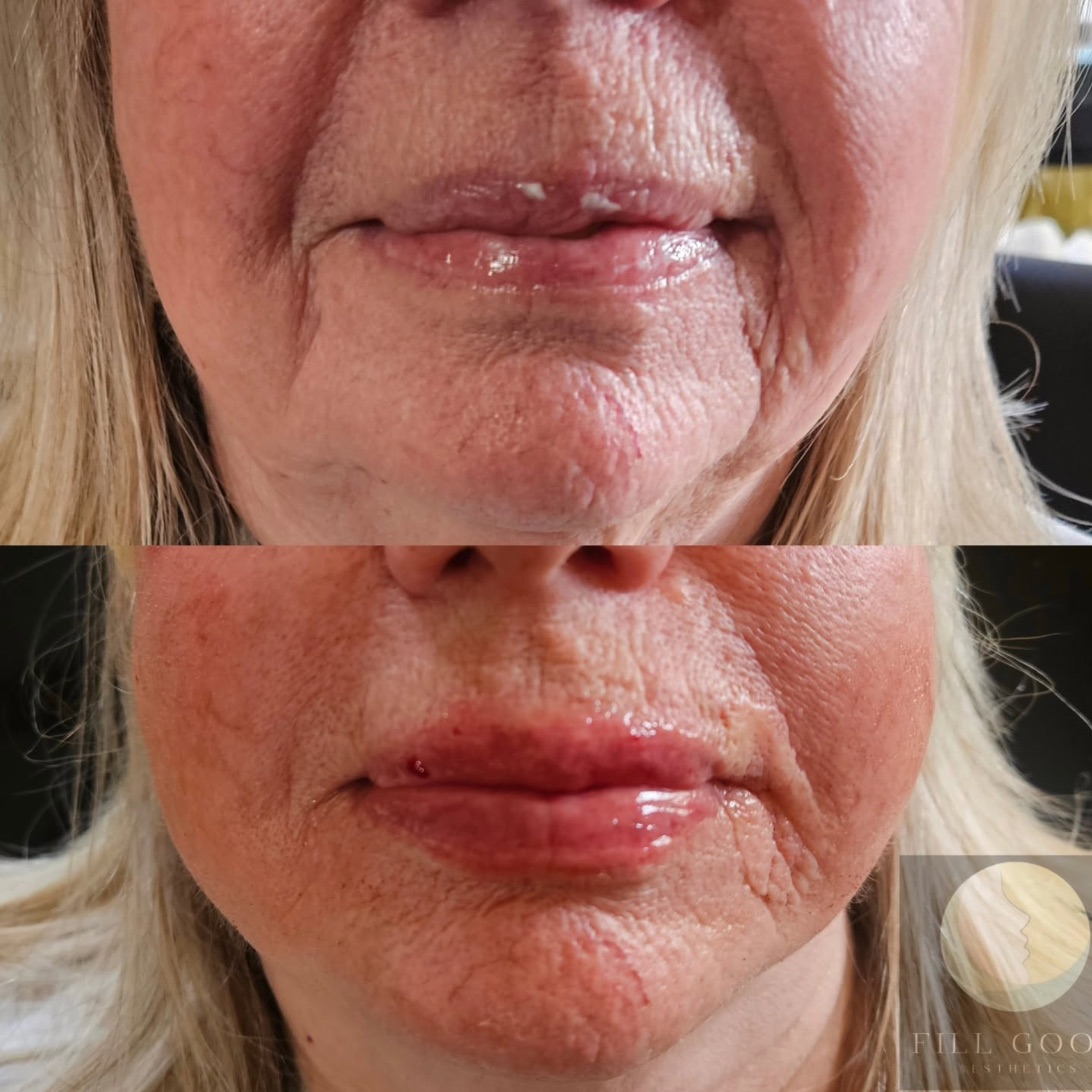 Before and after lip filler: the mouth and chin front on, before above and after below. The after photograph shows small red marks on the lips.