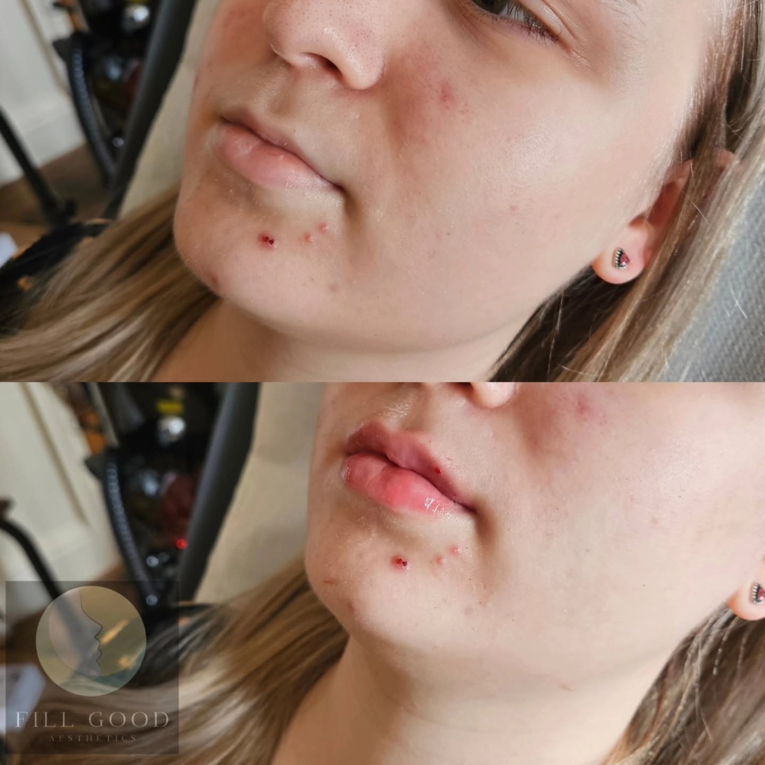 Before and after lip filler: the lower face from slightly below, before above and after below. Both photographs show small marks on the chin.