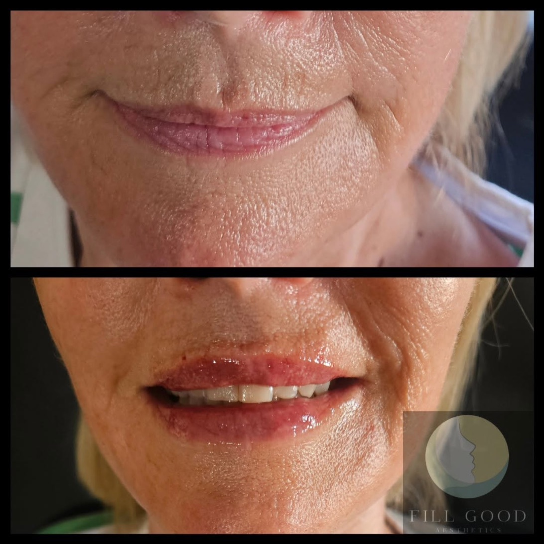 Before and after lip filler: the mouth front on, lips closed before and parted after, before above and after below.
