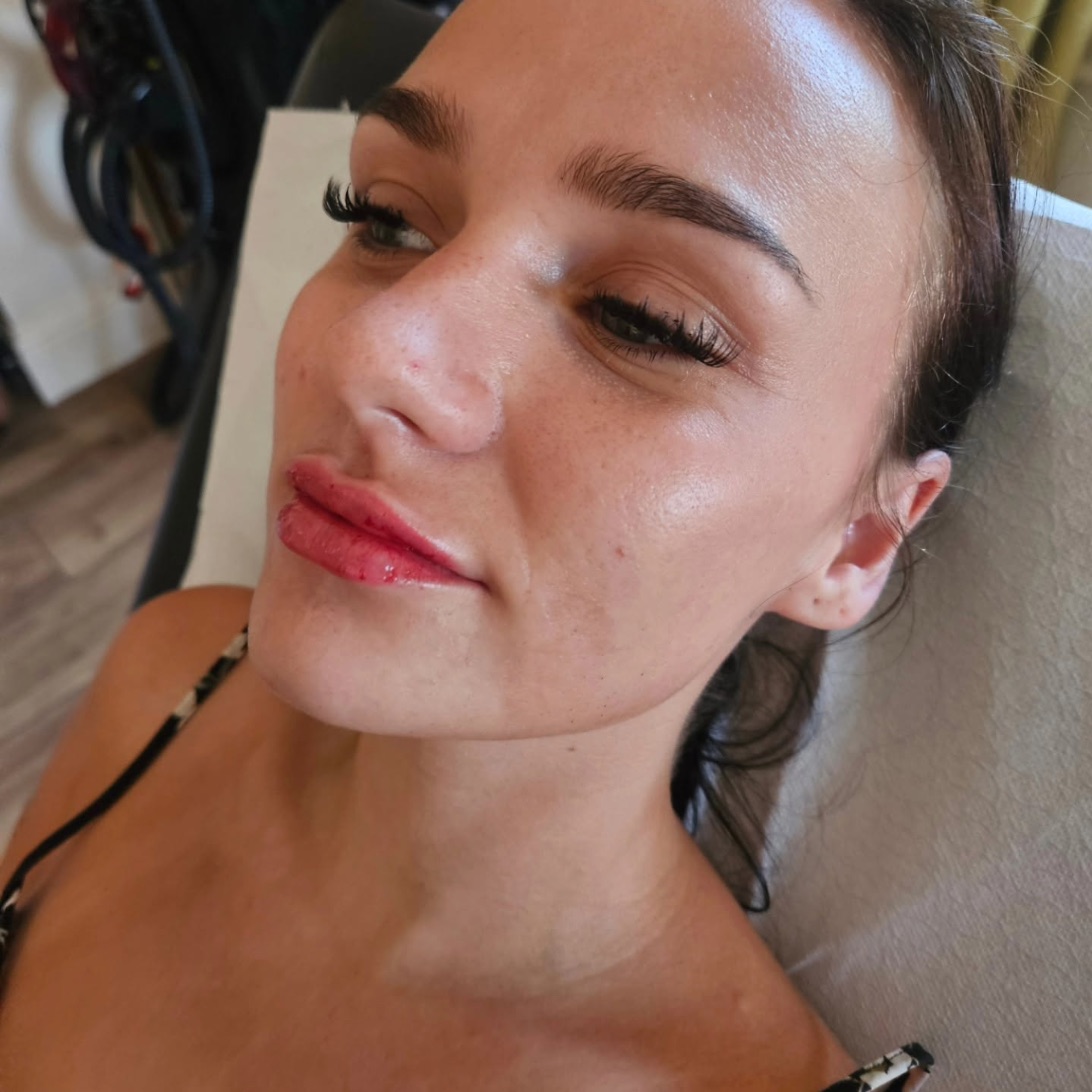 After lip filler: the face in three-quarter view, after treatment. Small red marks on the lips.