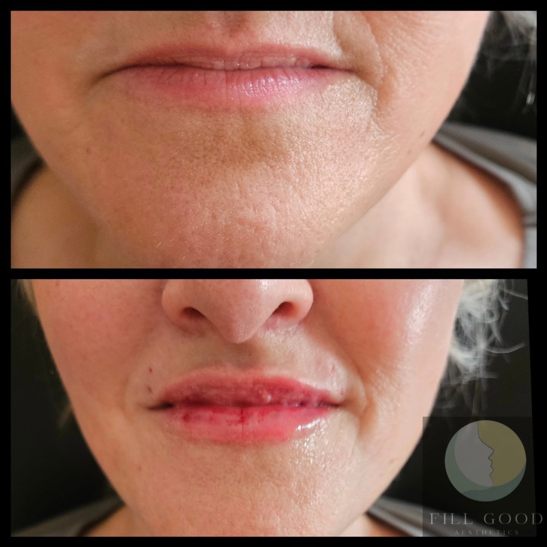 Before and after lip filler: the mouth front on, before above and after below. The after photograph shows small red marks around the lips.