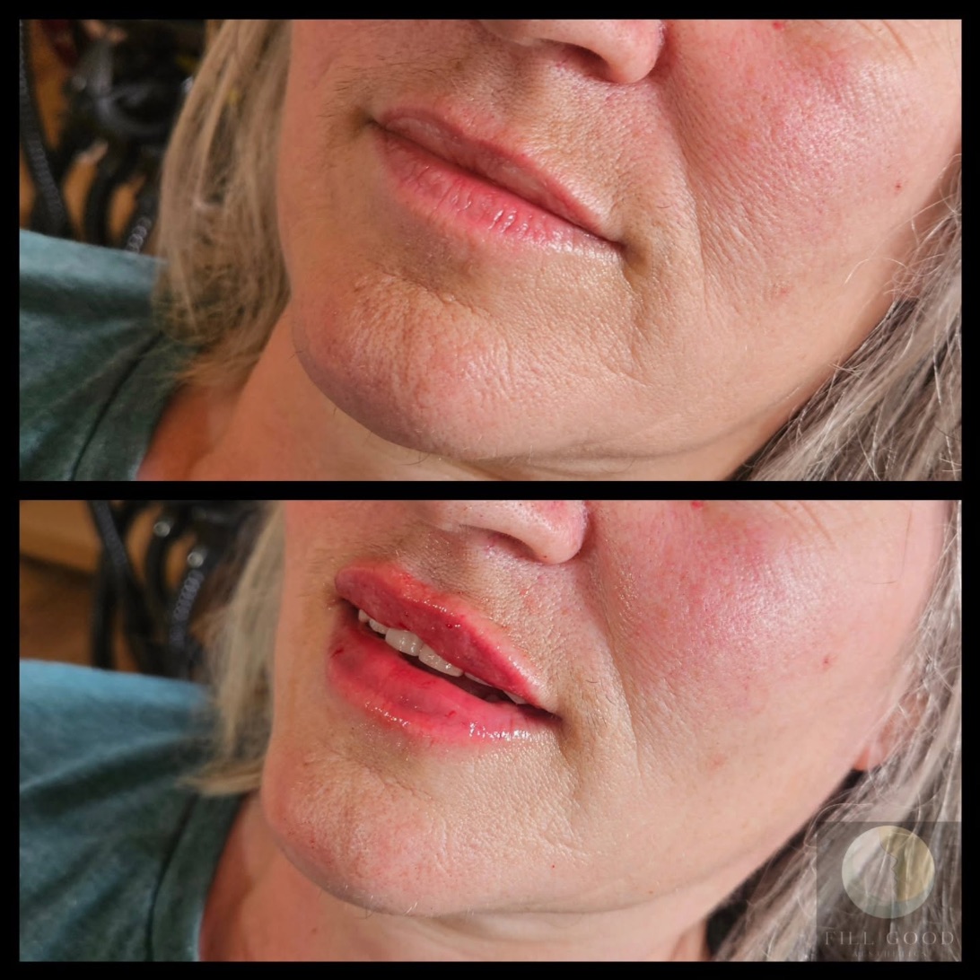 Before and after lip filler: the lower face from slightly below, before above and after below. The after photograph shows small red marks on the lips.